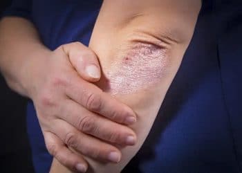 What to know about psoriasis treatment if not on medical aid