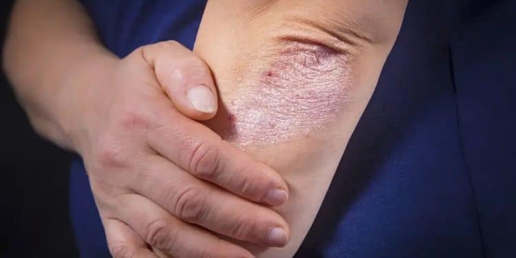 What to know about psoriasis treatment if not on medical aid