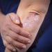 What to know about psoriasis treatment if not on medical aid