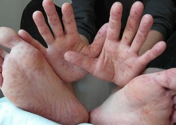 Foot and mouth disease