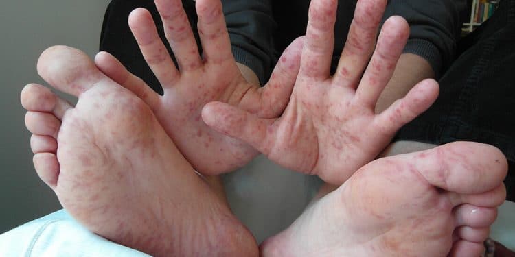 Foot and mouth disease