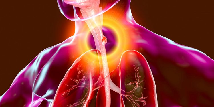 Maize is the main contributory factor to Oesophageal cancer, says a research study