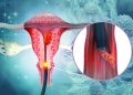 Can an ancient treatment be used to help fight cervical cancer?