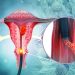 Can an ancient treatment be used to help fight cervical cancer?